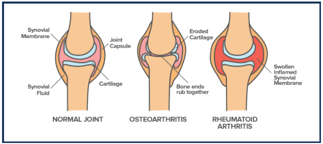 Arthritis