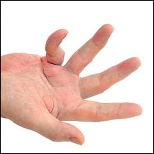 Dupuytren’s Contracture