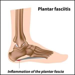 Planter Fasciitis